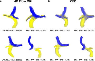 Characterization of baseline hemodynamics after the Fontan procedure: a retrospective cohort study on the comparison of 4D Flow MRI and computational fluid dynamics